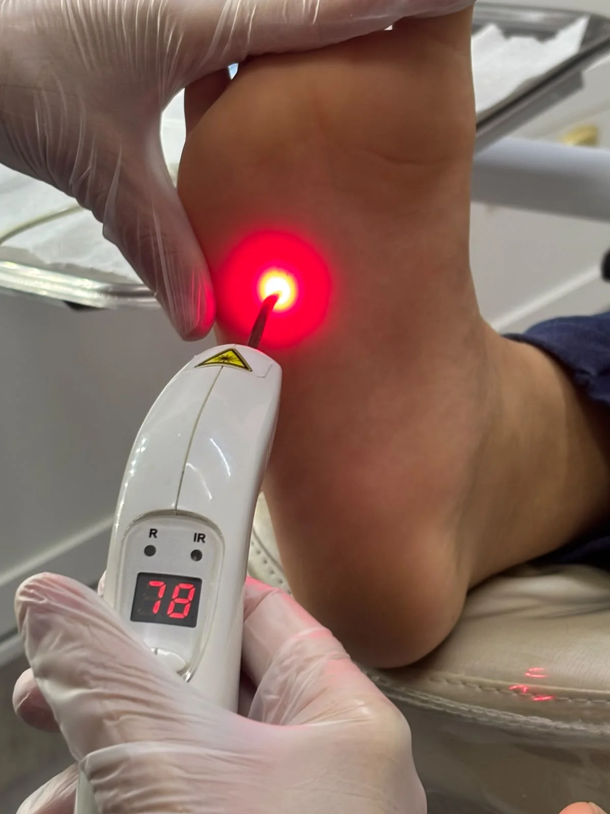 Aplicação de laserterapia em atendimento podológico